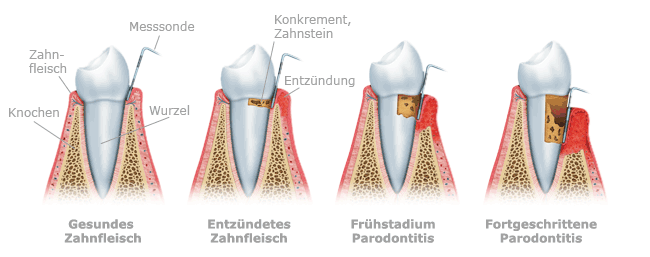 Parodontitis Parodontitis